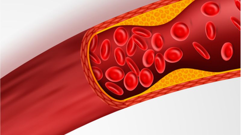 7-Ketocholesterol Drives Atherosclerosis