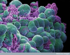 http://www.digitaljournal.com/img/3/1/6/7/3/3/i/1/5/3/p-medium/cancer_cells.jpg