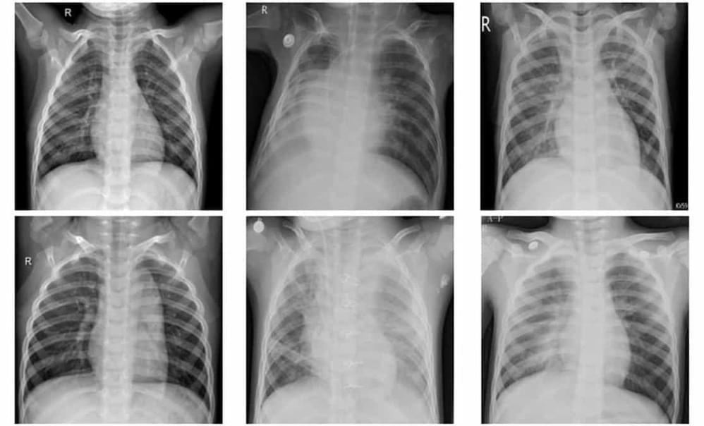 Device Learning Framework Classifies Pneumonia On Chest X Rays Hot