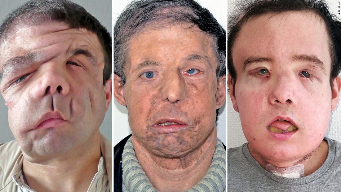 Man’s second face transplant is a world first