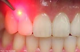 https://lifeboat.com/blog.images/researchers-use-light-to-coax-stem-cells-to-regenerate-teeth.jpg