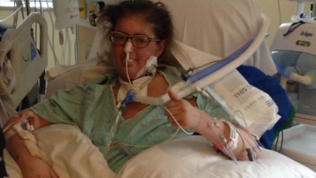 Woman Kept Alive For Six Days With No Lungs