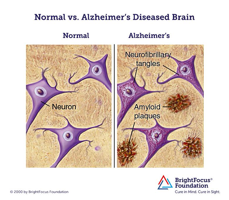 Deletion of BACE 1 Enzyme Reverses The Symptoms of Alzheimer's